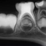 iopa pulpectomy