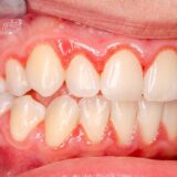 Desquamative Gingivitis_ Maintenance through Proper Oral Care In Lieu of Medication