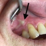 Emergency Dentist in My Area (Tooth Abscess)